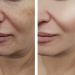 Skin Pigmentation Treatment in New Jersey | LenoyMED